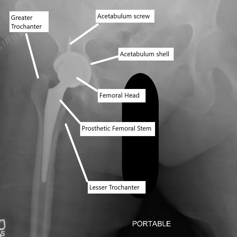 X-ray showing total hip replacement.