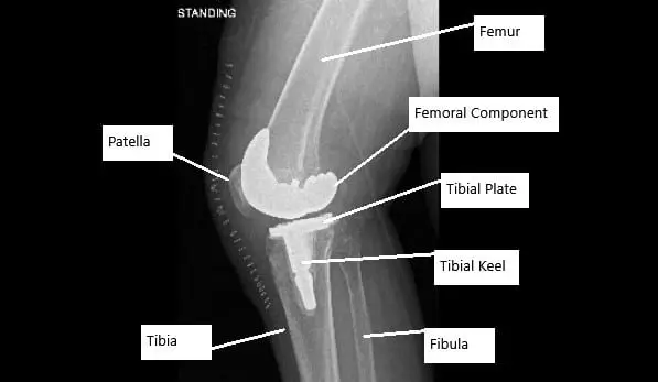 X-ray showing total knee replacement surgery in a patient with AVN knee.