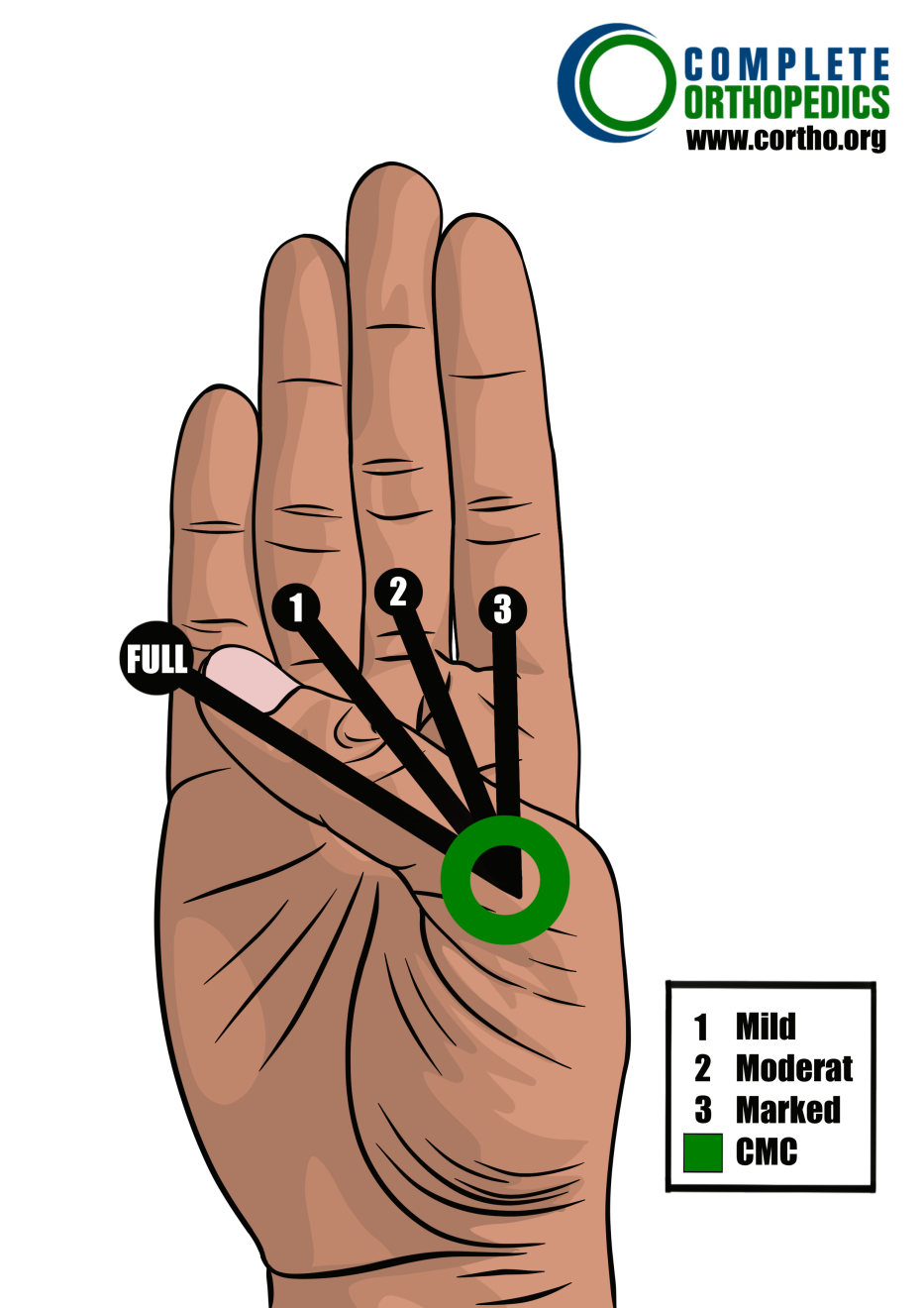 carpometacarpal joint of thumb to evaluate loss of motion to calculate scheduled loss of use for workers compensation patient