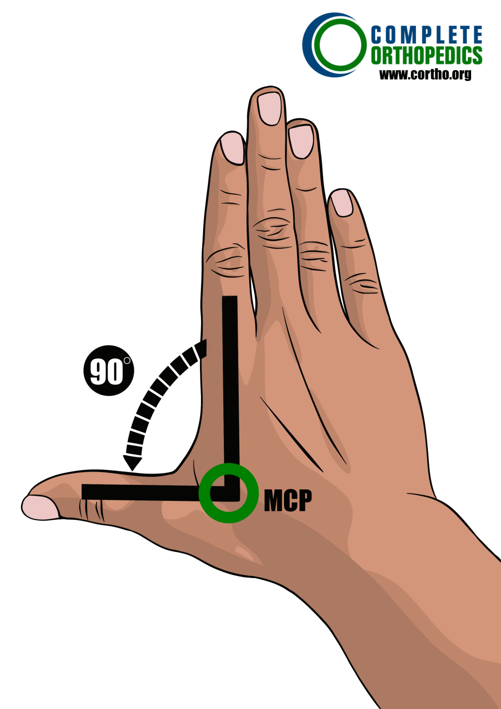 Radial Abduction of metacarpophalangeal joint to evaluate loss of motion to calculate scheduled loss of use for workers compensation patient
