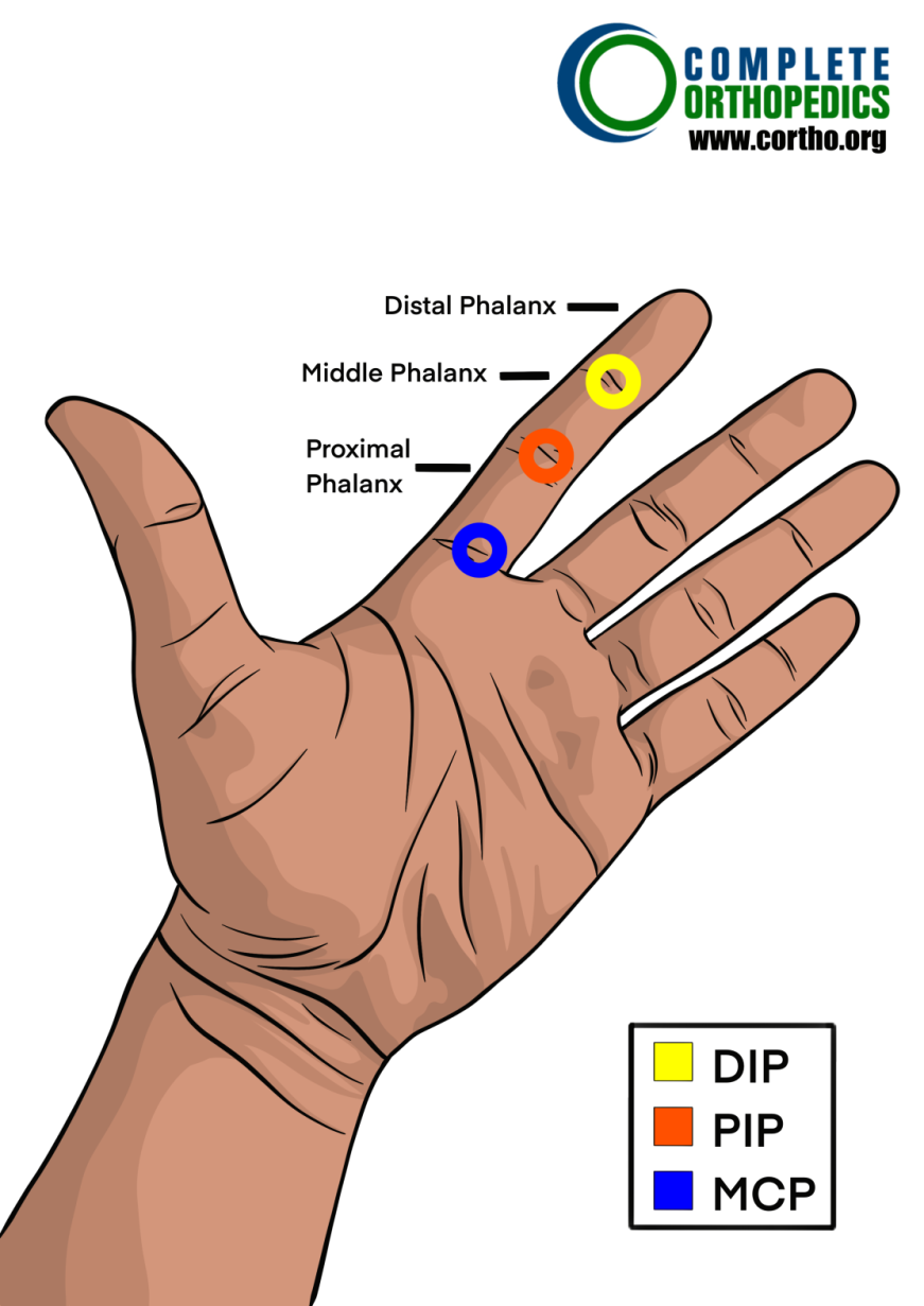 The metacarpophalangeal and proximal interphalangeal and distal interphalangeal joint to evaluate loss of motion to calculate scheduled loss of use for workers compensation patient