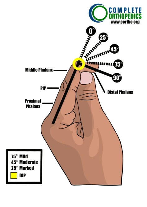 distal interphalangeal joint of finger to evaluate loss of motion to calculate scheduled loss of use for workers compensation patient