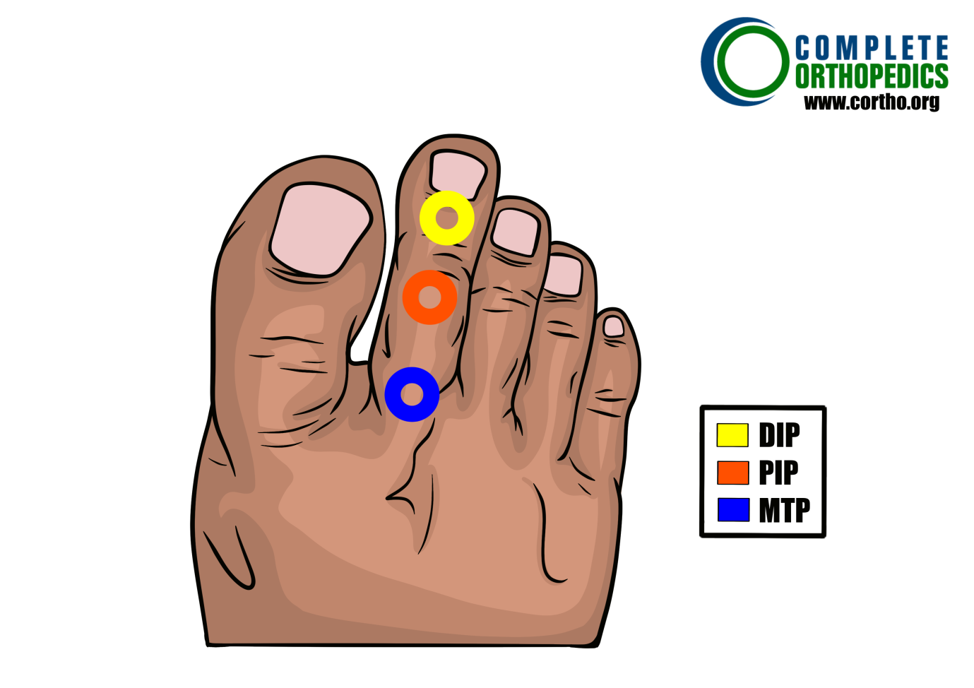 metatarsophalangeal joint and proximal interphalangeal joint and distal interphalangeal joint to evaluate loss of motion to calculate scheduled loss of use for workers compensation patient
