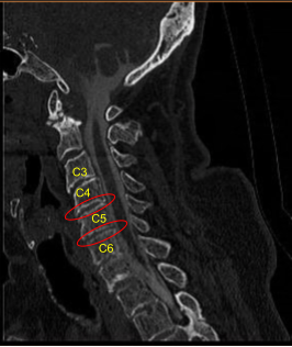 Cervical Spondylotic