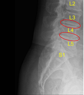 Disc space narrowing at L3-L4 and L4-L5