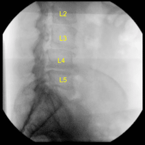 Intraoperative X-ray