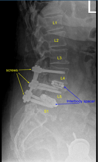 Laminectomy and Fusion sample (4)