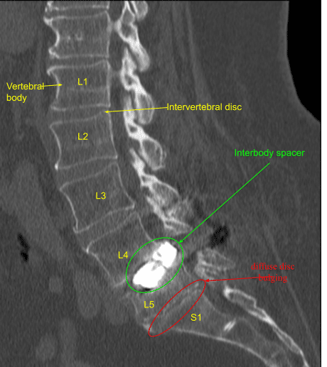 Laminectomy and Fusion sample 