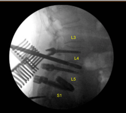 Laminectomy and Fusion sample (2)