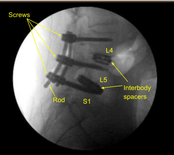 Laminectomy and Fusion sample (3)