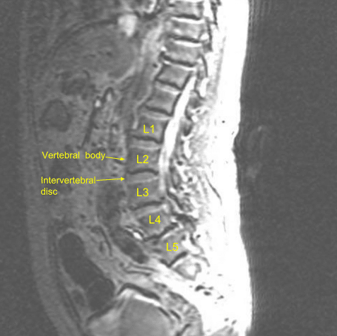 Sagittal view of pre-op Lumbar Spine MRI