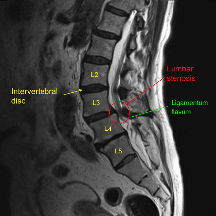 Sagittal view of pre-operative Lumbar Spine MRI