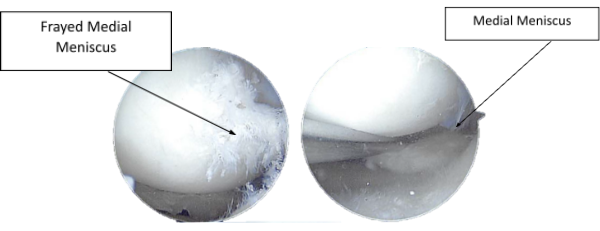 Figure 2.1. Intraoperative Arthroscopy Images