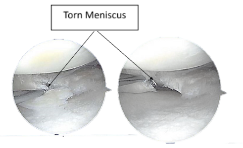 Figure 2.2. Intraoperative Arthroscopy Images
