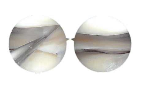 Figure 2.3 Arthroscopic view tear of the lateral meniscus posterior horn
