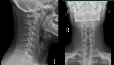 Cervical Spine X-ray 2 Views