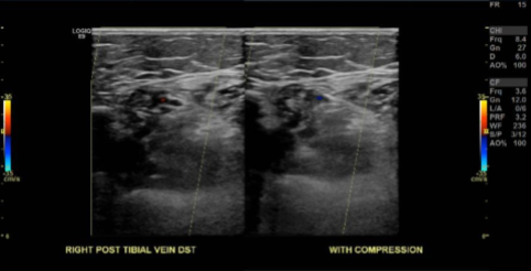 Doppler Venous Right Lower Extremity