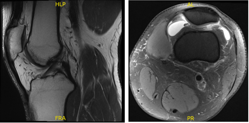 Fig. 1 MRI of the left knee in sagittal and coronal sections.