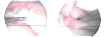 Final pictures showing operative part dressed