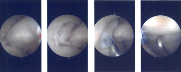 Intraoperative Arthroscopy Images