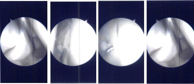 Intraoperative Arthroscopy Images