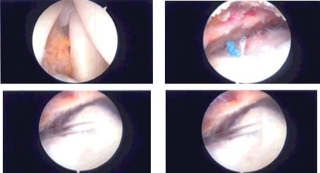 Intraoperative Arthroscopy Images