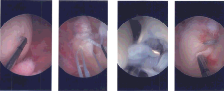 Intraoperative Arthroscopy Images