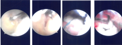 Intraoperative Arthroscopy Images