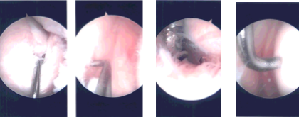 Intraoperative Arthroscopy Images