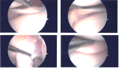 Intraoperative Arthroscopy Images