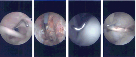 Intraoperative Arthroscopy Images