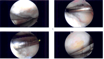 Intraoperative Arthroscopy Images