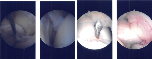 Intraoperative Arthroscopy Images
