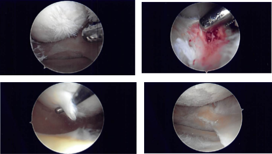 Intraoperative Arthroscopy Images