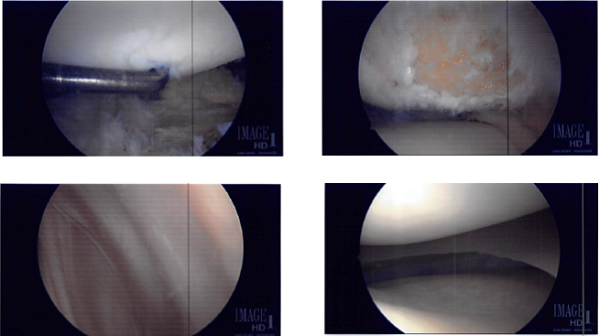 Intraoperative Images from start to final process