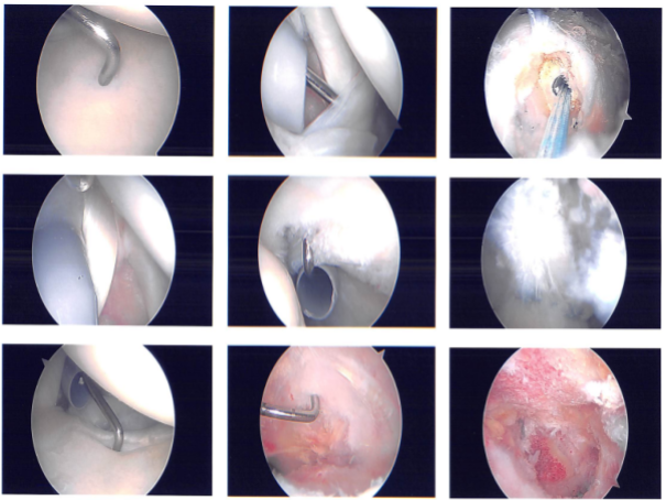 Intraoperative images