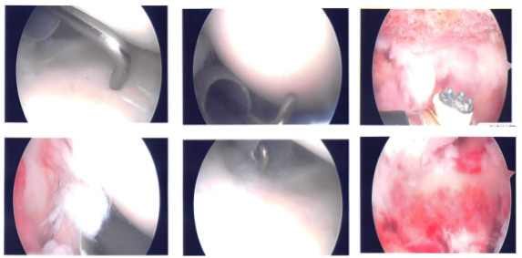 Intraoperative photo