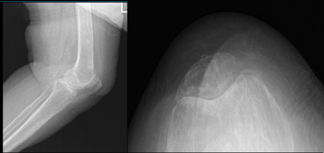 Left Knee X-ray AP and Lateral with Oblique 3 views