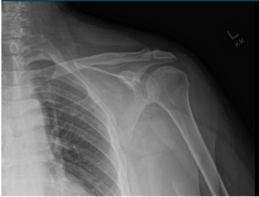 Left Shoulder X-ray