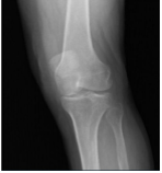 Left knee X-ray AP and Lateral with oblique views