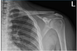 Left shoulder X-ray