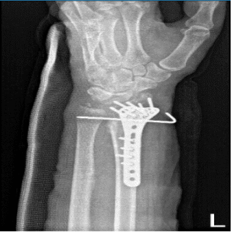 Left wrist x-ray 2 views