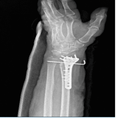 Left wrist x-ray 3 or more views