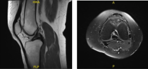 MRI -3 T Left Knee Non-contrast