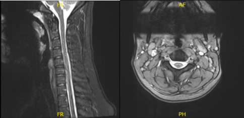 MRI-3T Cervical Spine Non-contrast