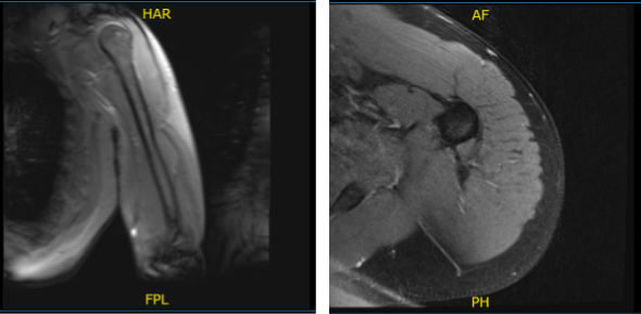 MRI-3T Left Arm Non-contrast