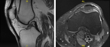 MRI-3T Left Knee Non-contrast