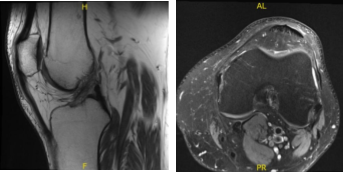 MRI-3T Left Knee Non-contrast