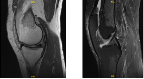 MRI-3T Left knee non-contrast