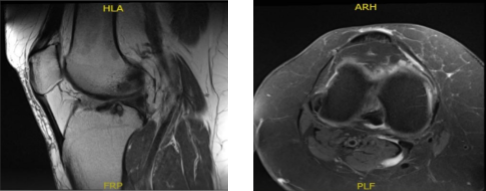 MRI-3T Right Knee Non-contrast